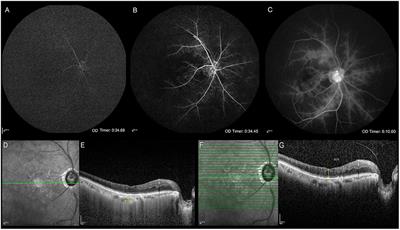 Blood flow perfusion in visual pathway detected by arterial spin labeling magnetic resonance imaging for differential diagnosis of ocular ischemic syndrome